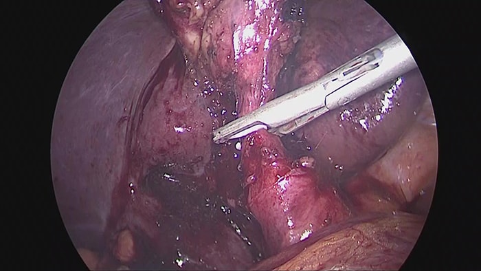 腹腔鏡下胆のう摘出の写真