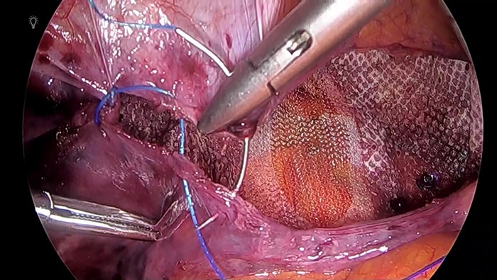 鼡径ヘルニアに対する腹腔鏡下ヘルニア修復術の写真2
