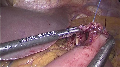 前庭部胃がんに対する腹腔鏡下幽門側胃切除術の写真
