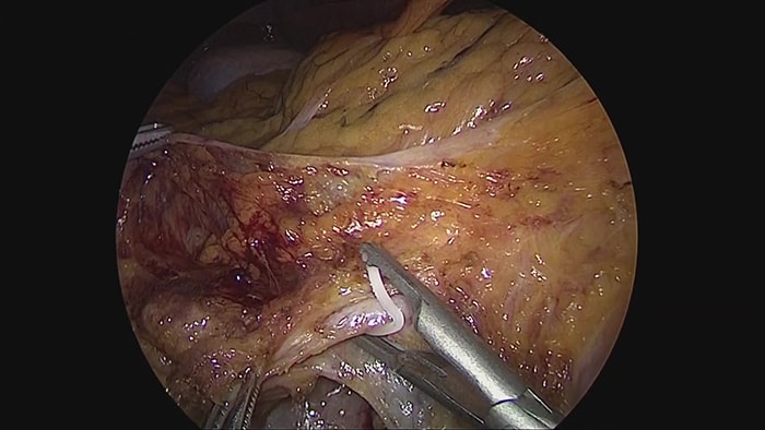 上行結腸がんに対する腹腔鏡下右半結腸切除術の写真