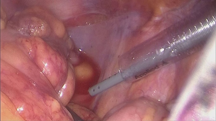 S状結腸がんに対する腹腔鏡下S状結腸切除術の写真